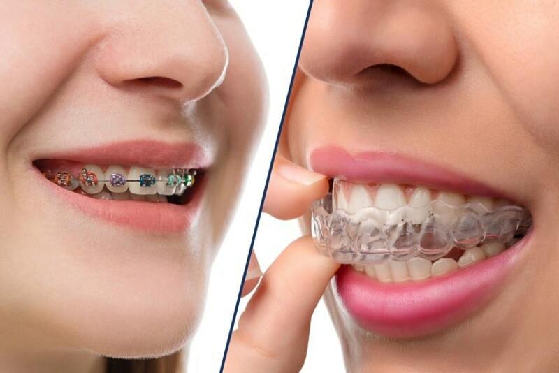 Những phương pháp niềng răng phổ biến nhất hiện nay